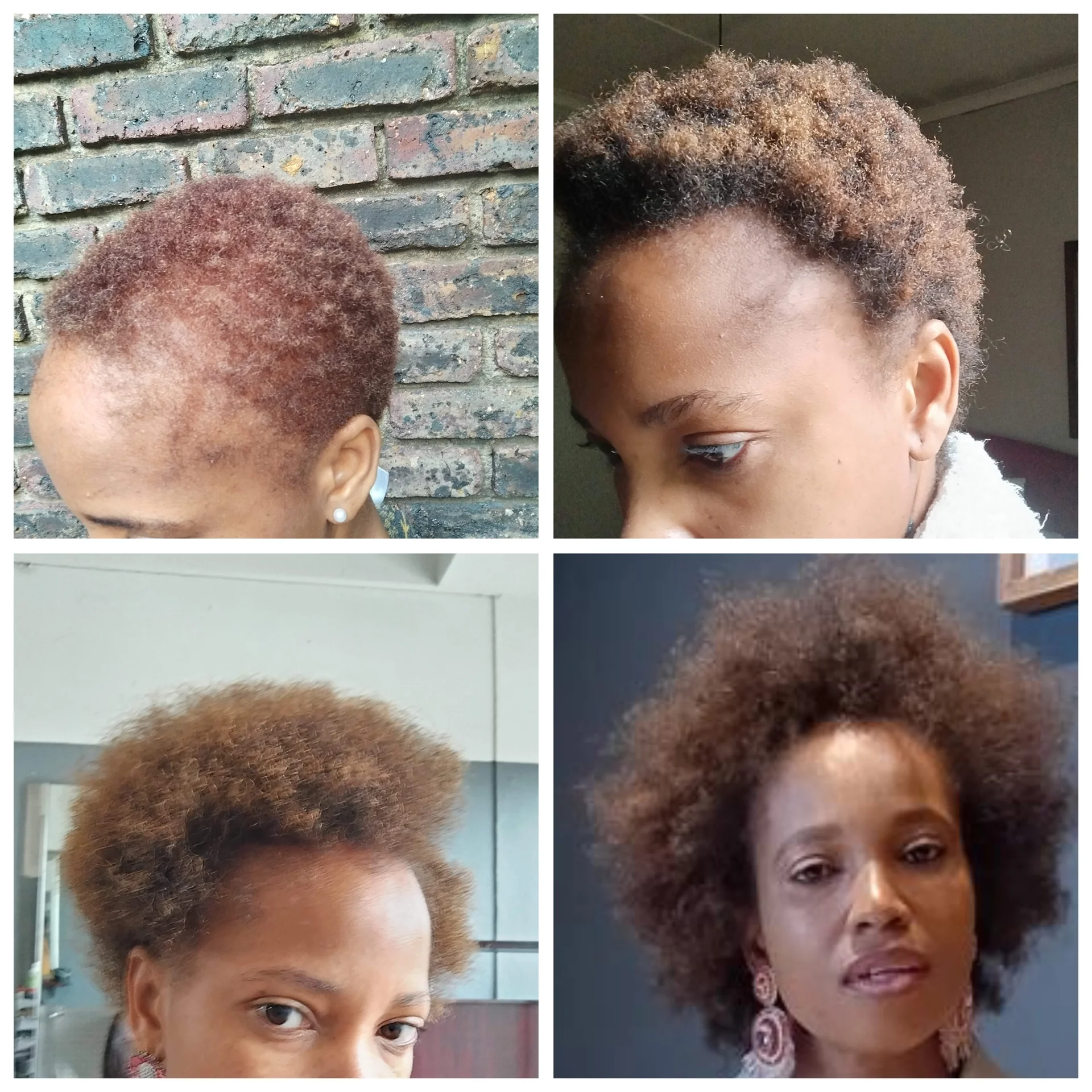 Hair restoration treatment before and after results showing significant density improvement